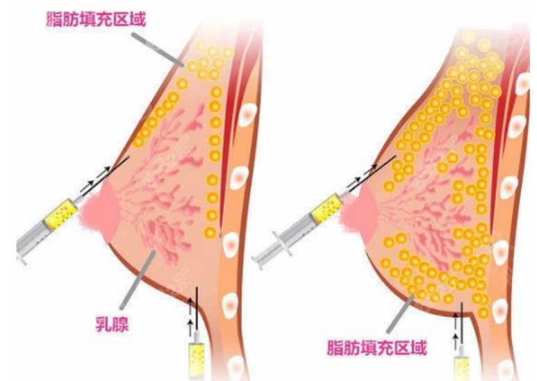 王沛森丰胸