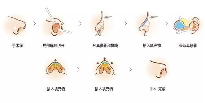 鼻小柱延长可以改善什么