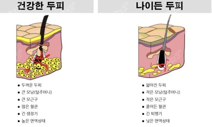 注入脂肪加强毛囊的强韧