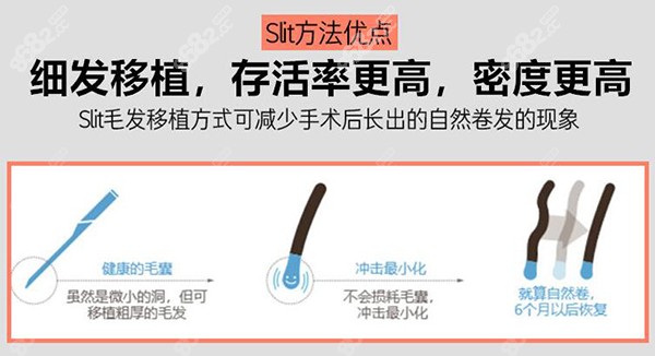 美国slit植发方法