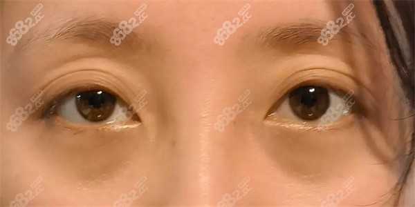 雙眼皮好幾層怎么解決？