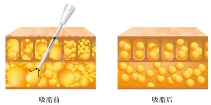 长沙美研高敏抽脂怎么样