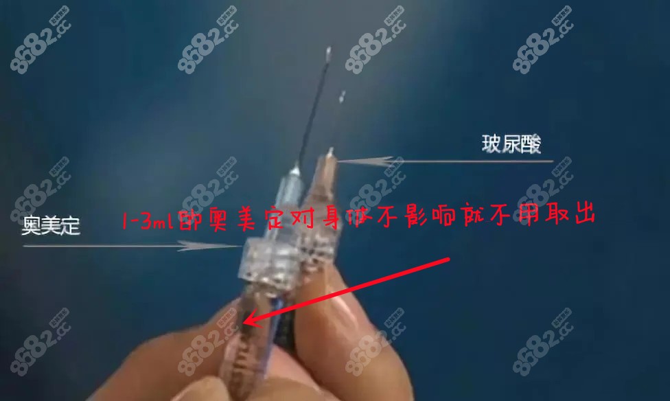 鼻子剩余1-3ml的奥美定经过检查后看是否要取出