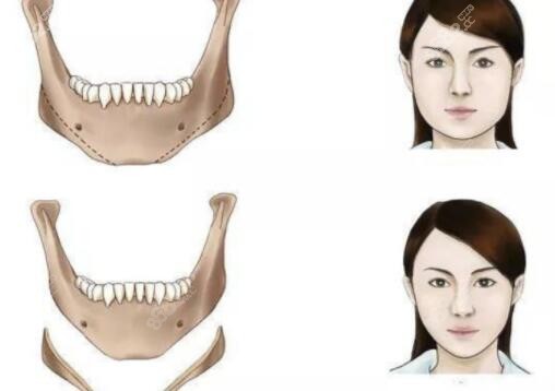 石家莊有做下頜角的醫(yī)院嗎