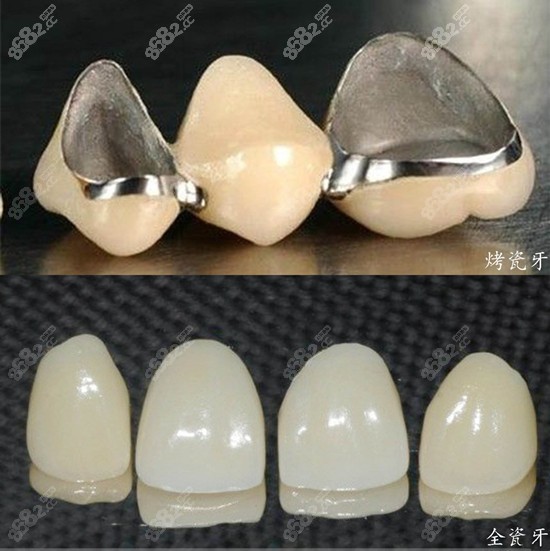 全瓷冠比烤瓷冠贵多钱www.8682.cc