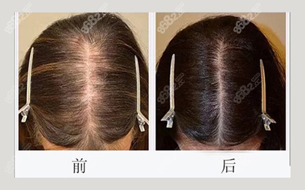 韩国头顶加密植发8682.cc