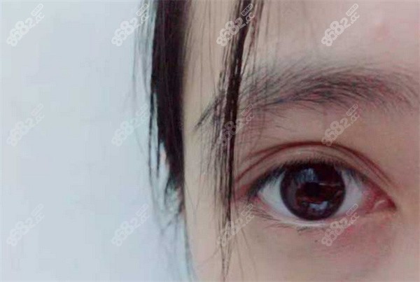 雙眼皮好幾層怎么解決？