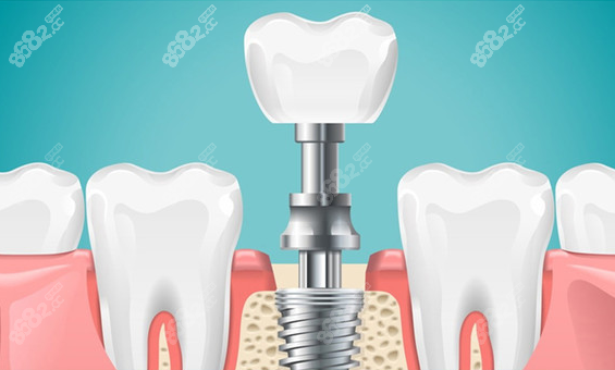 种植牙的套路价格