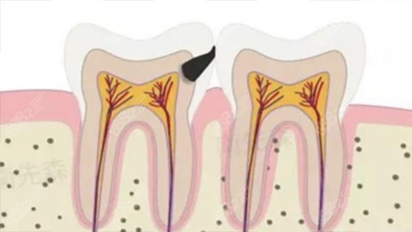 牙齿龋坏