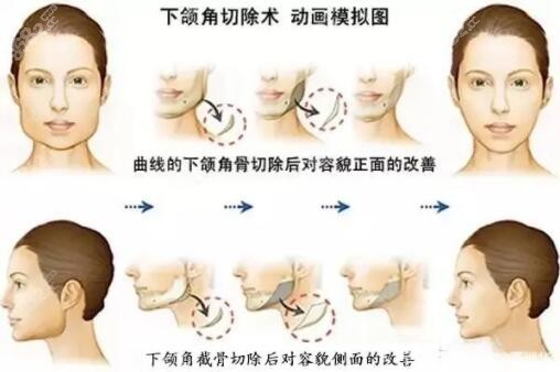 石家莊能做下頜角整形的醫(yī)院有哪家