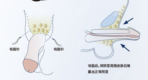 阴茎延长手术方法