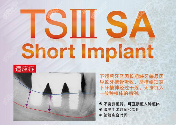 韩国奥齿泰TS III SA植体优势