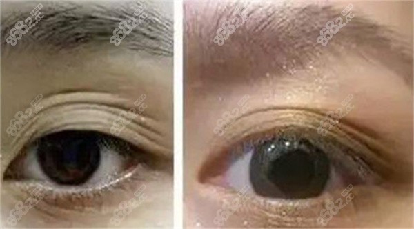 雙眼皮好幾層什么原因？