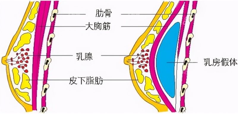 罗盛康医生隆胸