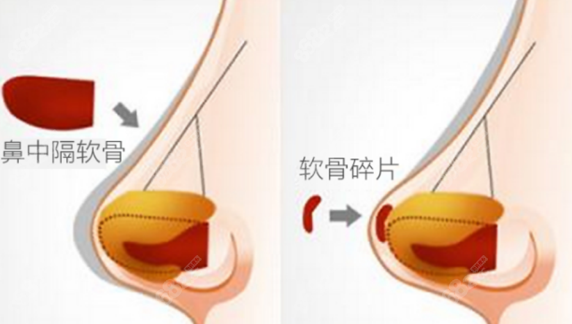 谢福庚和朱灿谁做鼻子