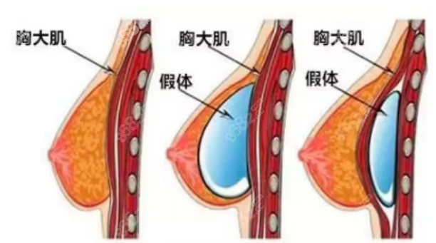 罗盛康医生隆胸