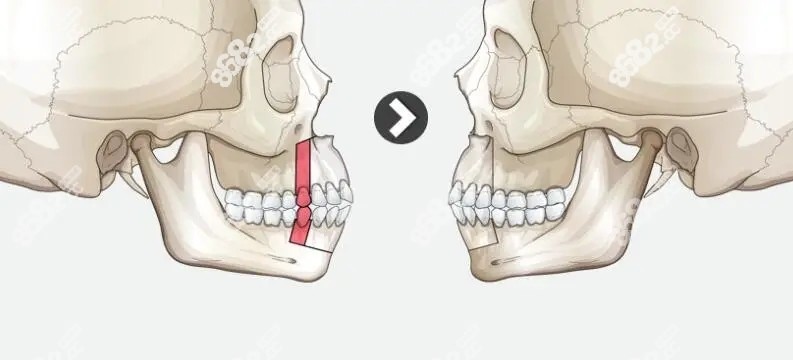 中国做正颌和韩国双鄂手术部位
