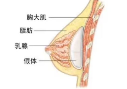 <!--<i data=20240705-sp></i>-->医生隆胸