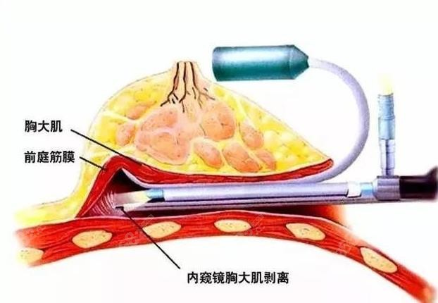 内窥镜丰胸