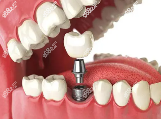 珠海九龙口腔医院种植牙系统8682.cc