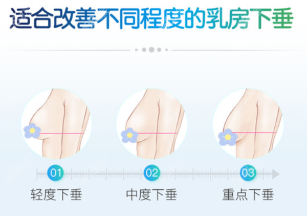 韩国歌柔飞医院乳房下垂矫正费用