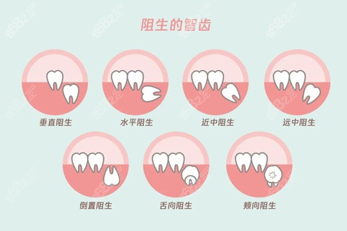 智齿生长不同拔牙价格也不同