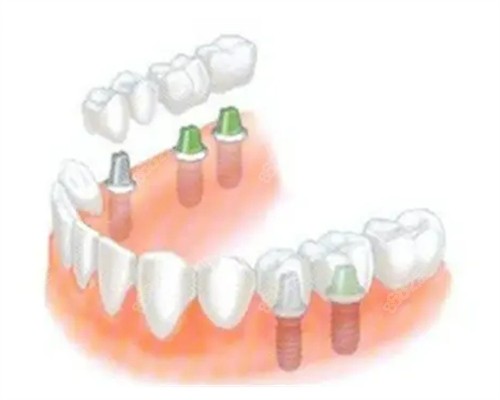南通摩尔口腔种植牙便宜又好