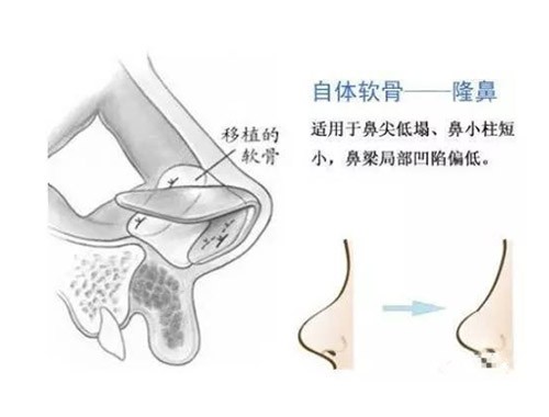 自体软骨隆鼻