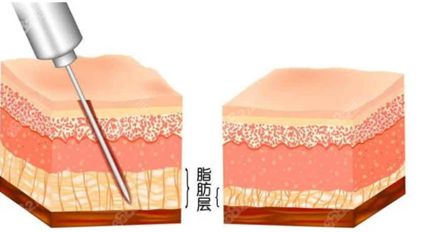 吸脂手术