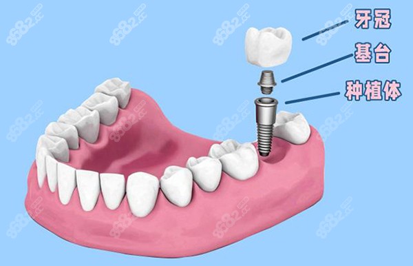 小白兔口腔种植牙价格