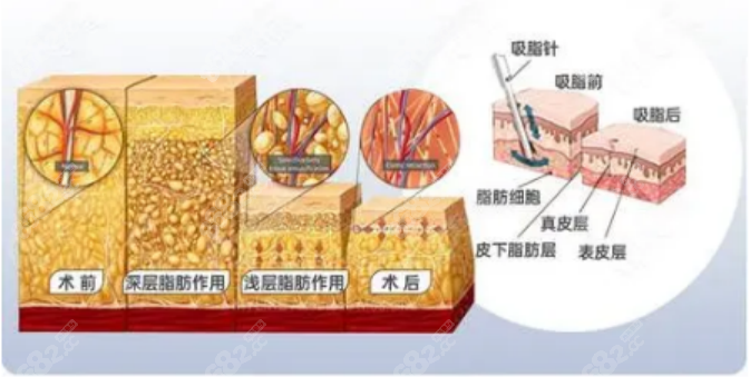 杨灿龙医生吸脂怎么样？