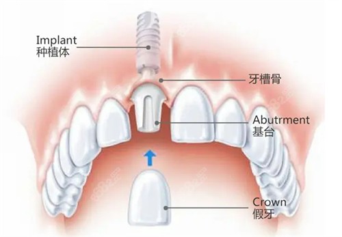 南通摩尔口腔医生做种植牙技术扎实