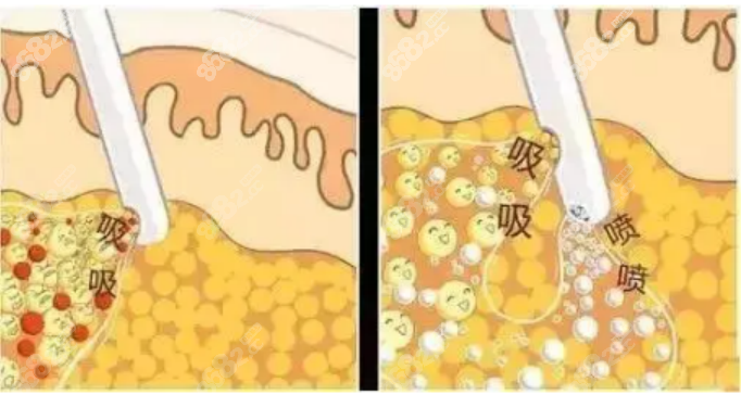 吸脂手术