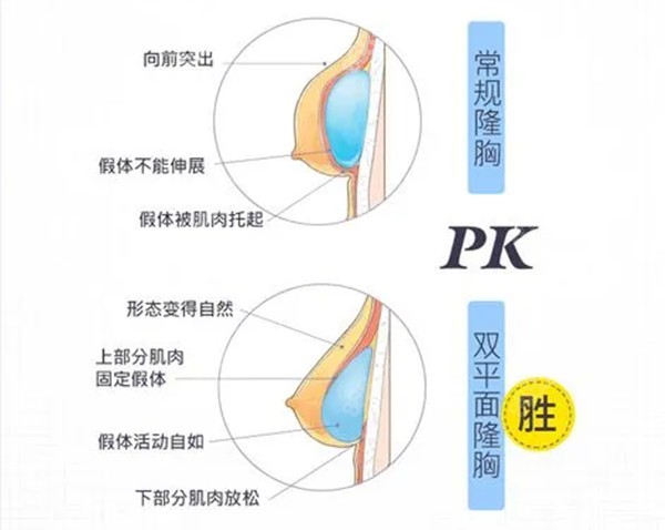 内窥镜隆胸和普通隆胸区别