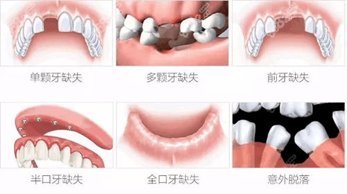 缺牙种类