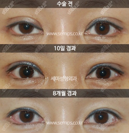 韩国世美修复肉条眼对比示例