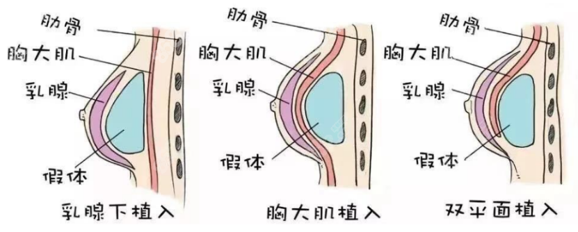 刘月更隆胸