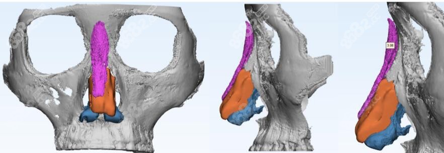 3D打印鼻假体模拟图