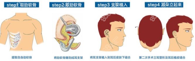 耳朵整形哪家医院好揭秘