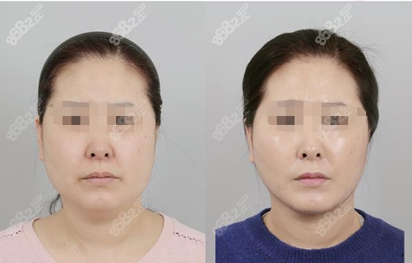 韩国ID医院面部提升病例