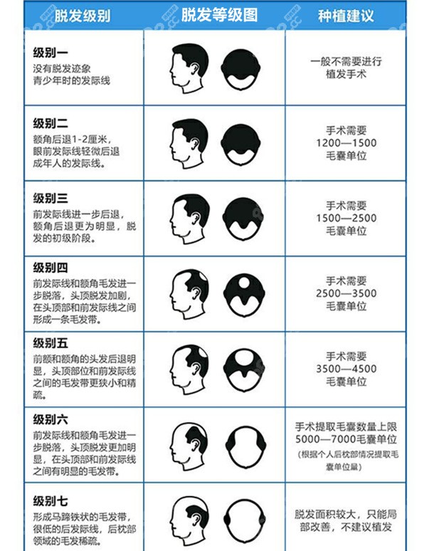 脱发1-7级程度图片图片