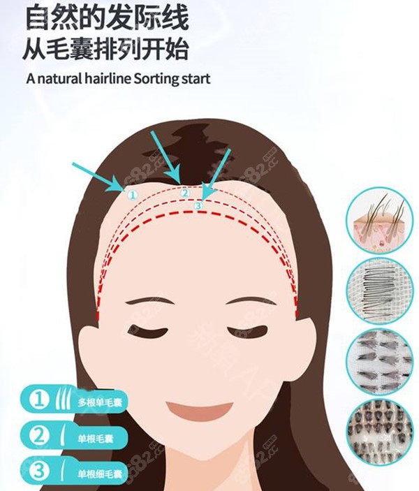 临沂发际线植发多少钱