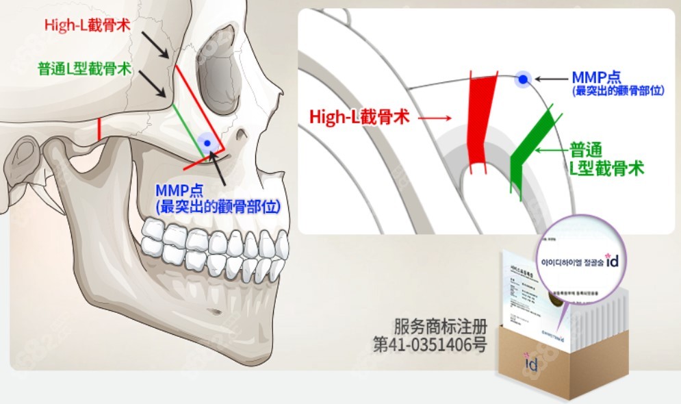 韩国id李知赫院长颧骨内推技术特色