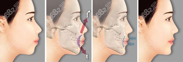 下巴后缩矫正手术