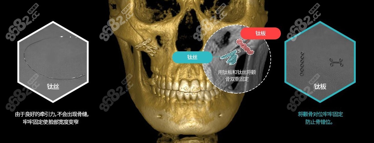 李相均颧骨内推技术优势m.8682.cc分享