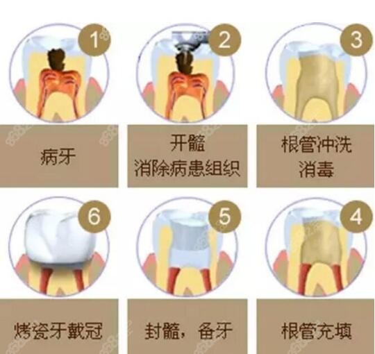 根管治疗操作步骤示意图