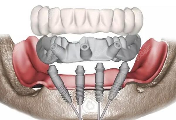ALL-ON-4种植牙技术的力学设计8682.cc