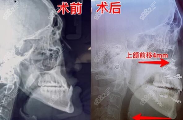 中国微创正颌手术哪里做得好