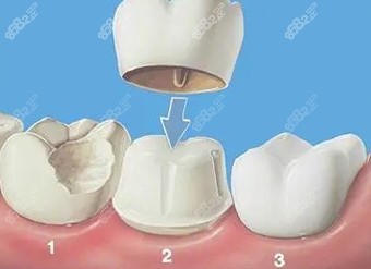种植牙牙冠是粘上去的还是拧上去的