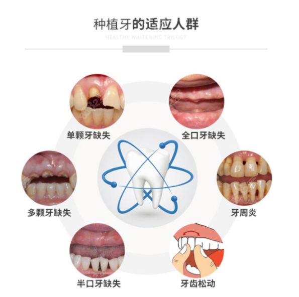 有需要做种植牙的人群8682.cc